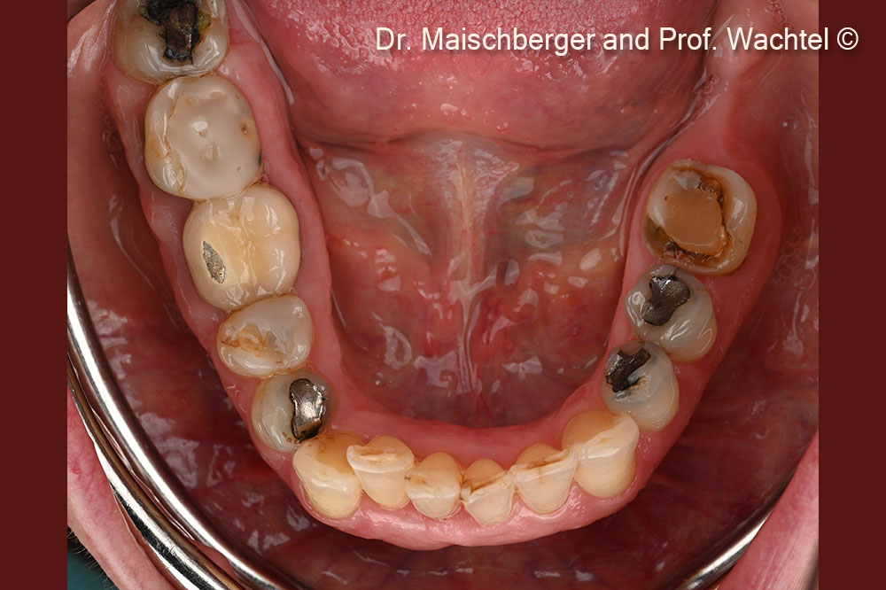 Intraoral occlusal view lower jaw – initial situation.