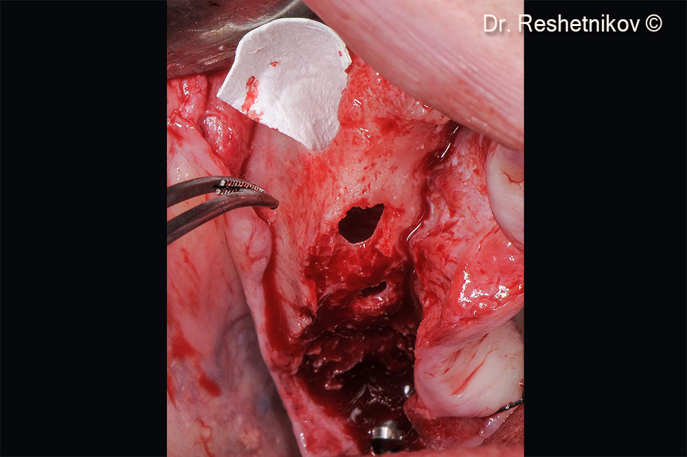 Isolation of the oroantral anastomosis with collagen membrane Evolution. In positions #17, #12, #22, #25, #27, implants installed according to the V-II-V “All-on-4” protocol. Implant installed in position #15 using a delayed loading protocol