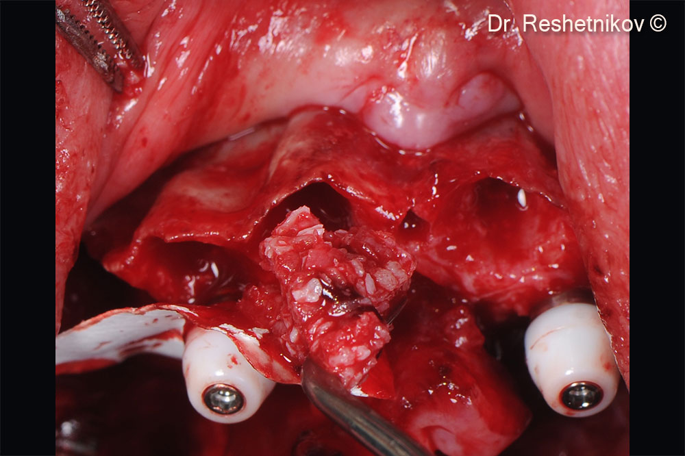 After implants' installation, the defects of the upper jaw and the sockets of the extracted teeth filled with mp3®. The graft isolated from the soft tissues by the collagen membrane Evolution