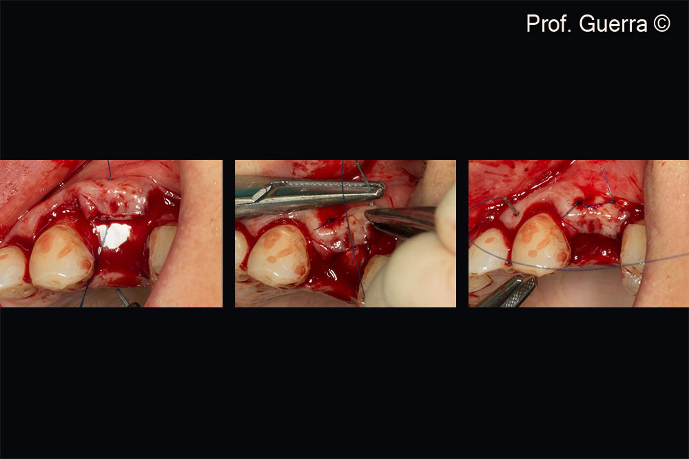 Left and Middle) horizontal mattress sutures (tension-free) mesially and distally; Right) interrupted suture in the papilla base between 22 and 23