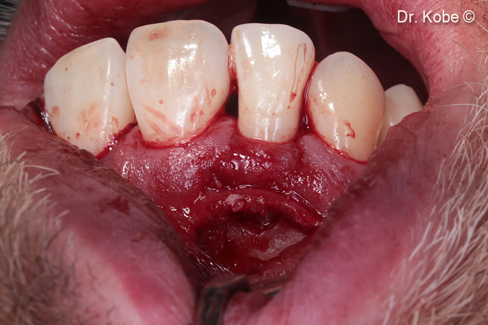 Defect filled with Gen-Os®