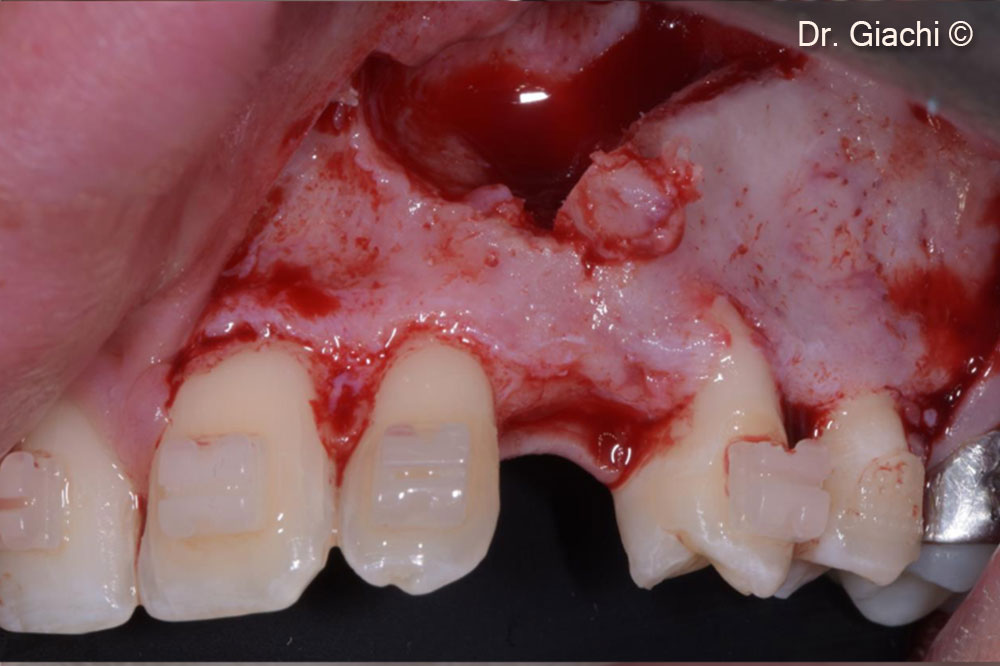 Atraumatic extraction and vestibular cortical preservation