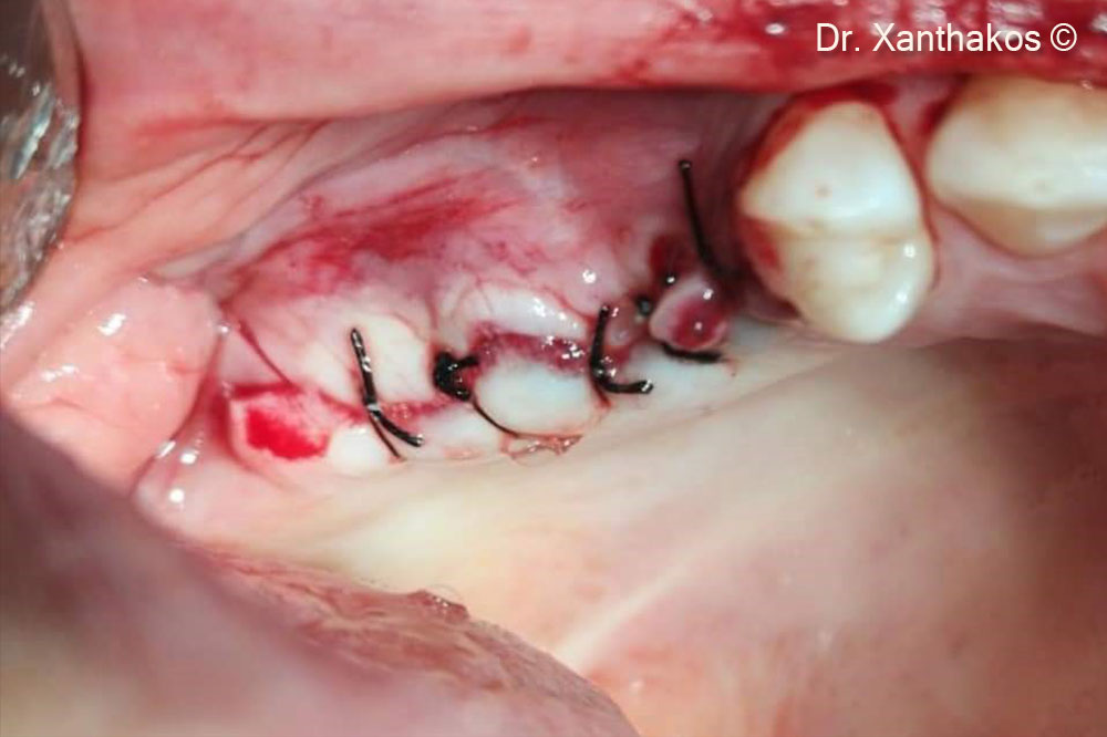 Wound was primarily closed with 4-0 silk-sutures after lengthening of buccal flap.