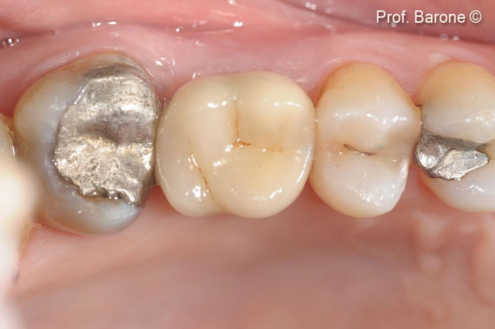 Final restoration, Occlusal View
