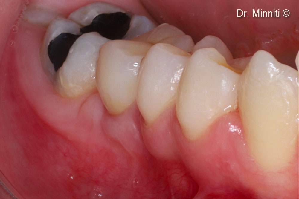 One-year follow-up withn the final restoration - lateral view