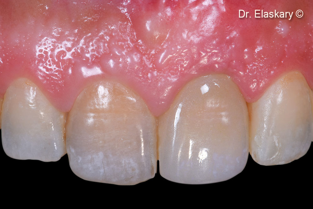 The final restoration in place shows a total restoration of the soft tissue margins
