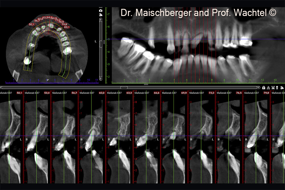 X-ray initial situation.