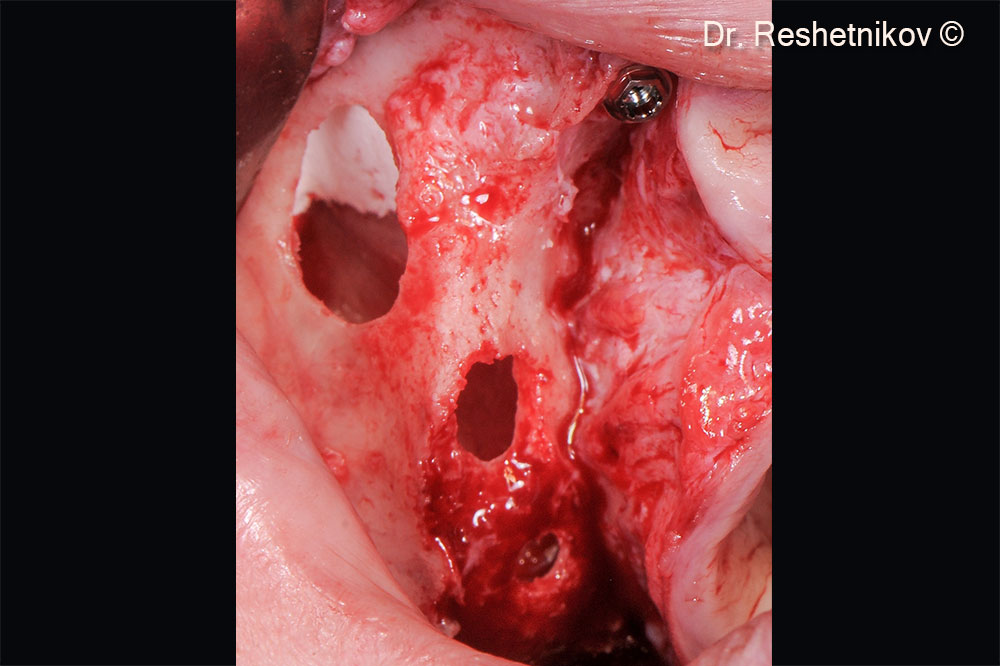 Isolation of the oroantral anastomosis with collagen membrane Evolution. In positions #17, #12, #22, #25, #27, implants installed according to the V-II-V “All-on-4” protocol. Implant installed in position #15 using a delayed loading protocol