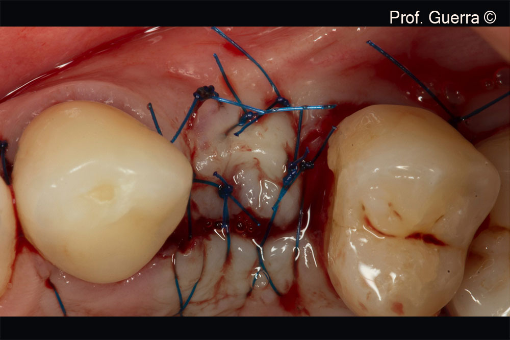 Suture final aspect