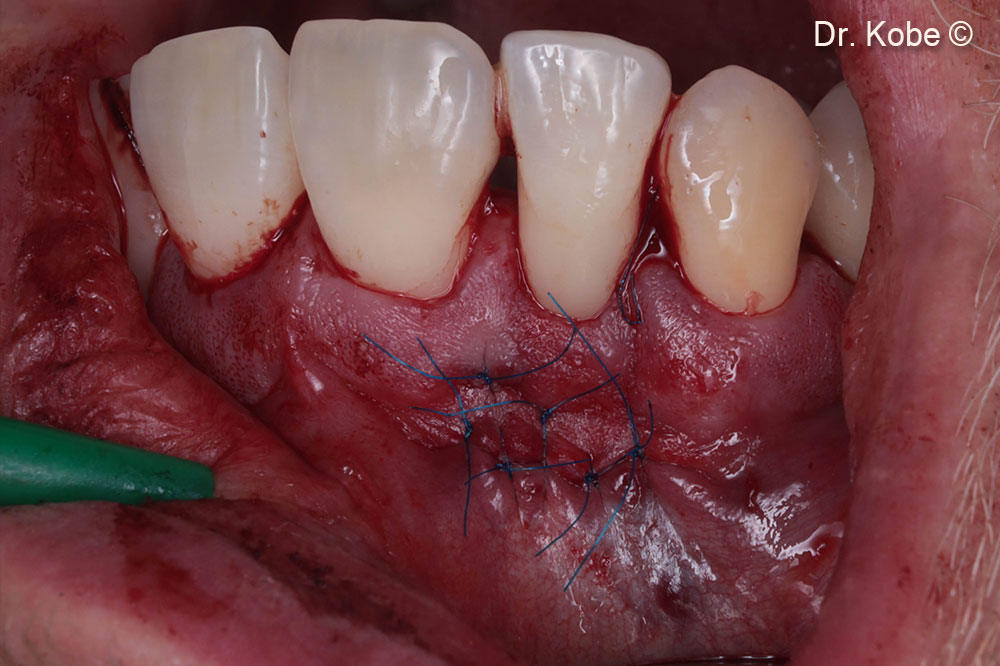 Wound sutured with interrupted sutures