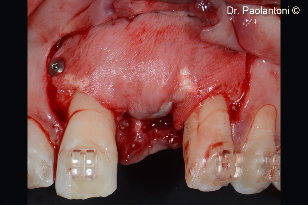 An Evolution collagen membrane is fixed with titanium pins