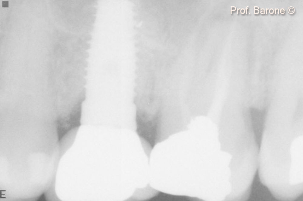 Periapical Radiograph after prothetic delivery