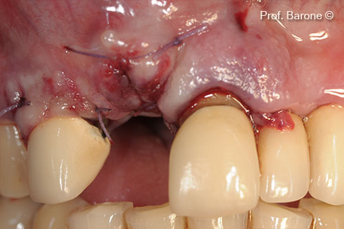 Soft tissue primary closure