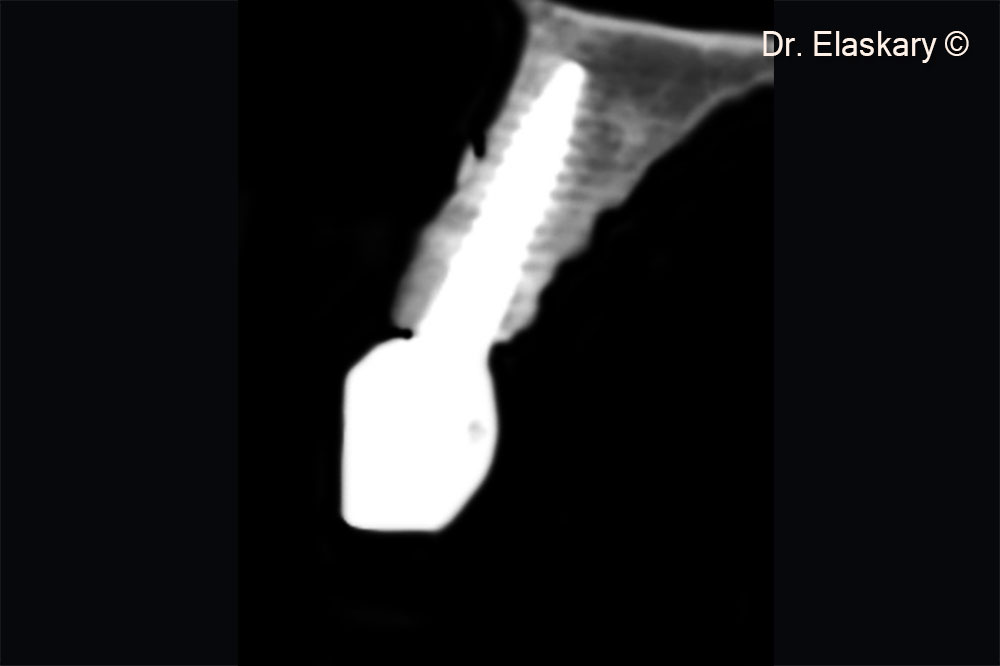 Two years post operative CBCT scan shows the regeneration of the labial plate of bone