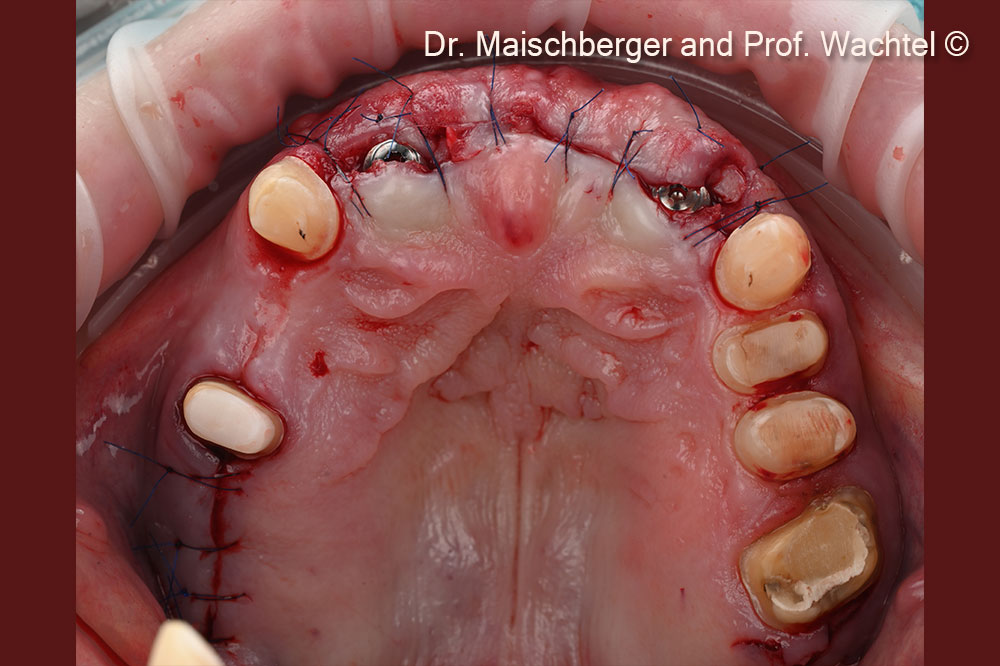 Intraoperative occlusal view upper jaw – simultaneous hard and soft tissue augmentation from region 12-22 using the Lamina®, GTO®, and subepithelial connective tissue graft.