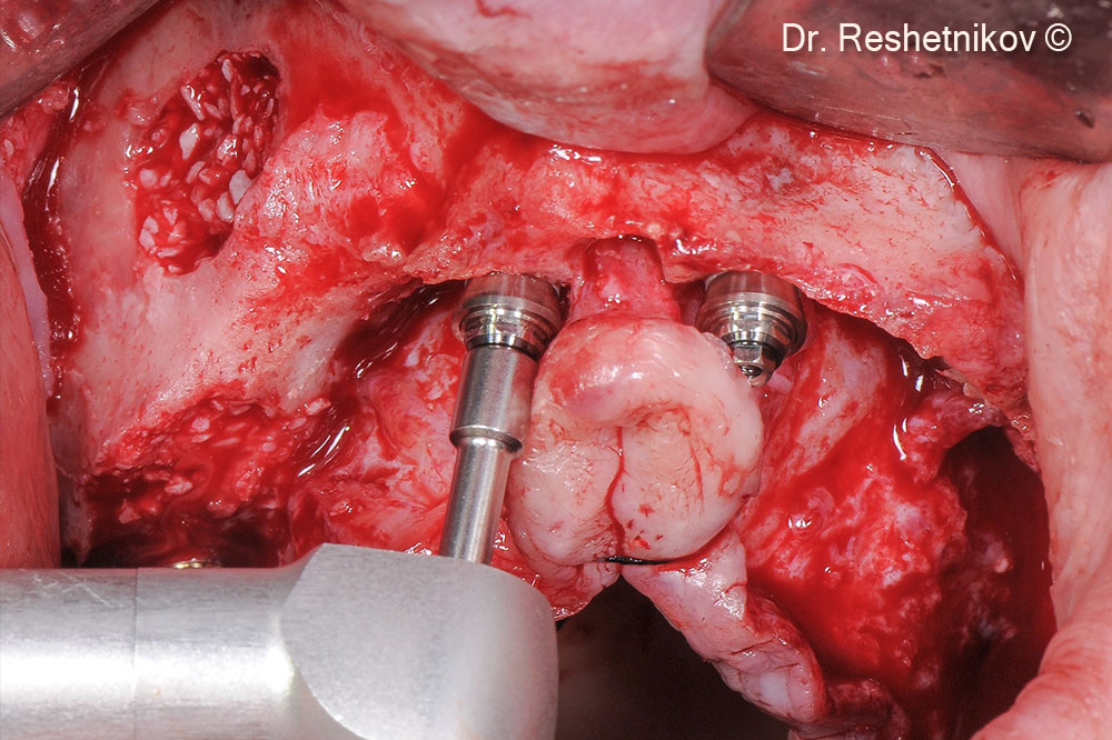 Void between the anterior wall of maxillary sinus and the Schneiderian membrane filled with mp3®. Multi-unit abutments installed on the implants