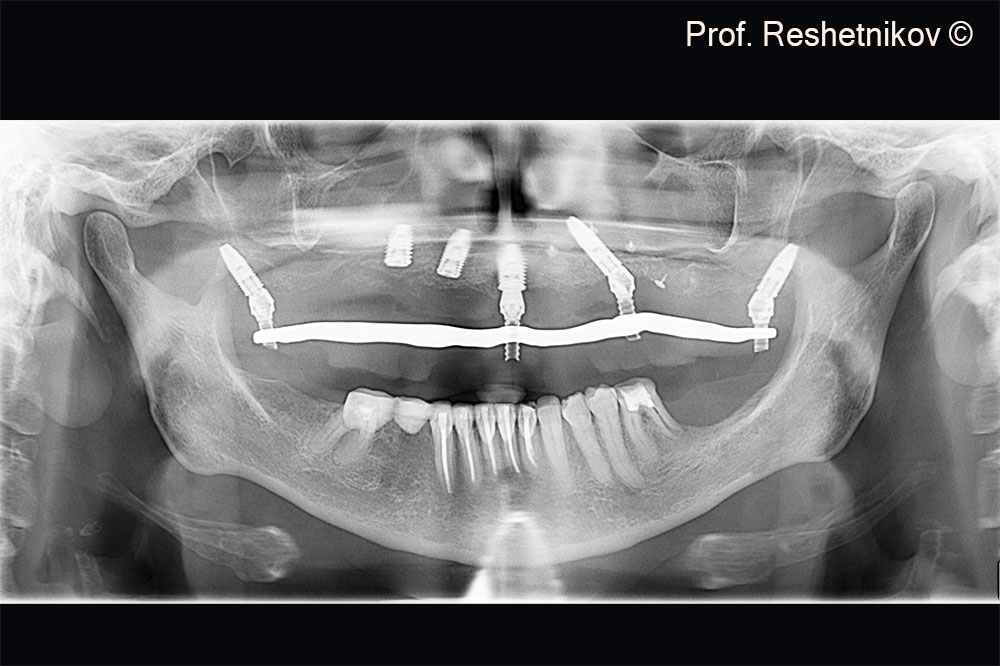 Panoramic radiograph on the day of surgery. Temporary reinforced plastic prosthesis installed