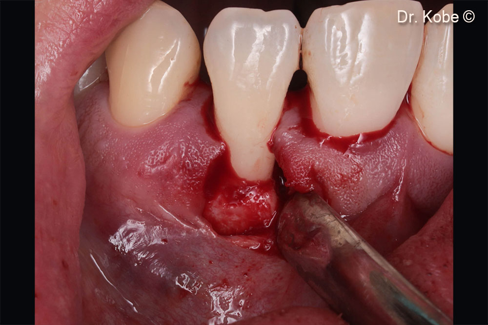 Vertical incision (EPPT) at the adjacent tooth