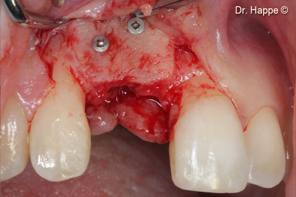 Regeneration of the ridge and integration of the lamina after 4 months.