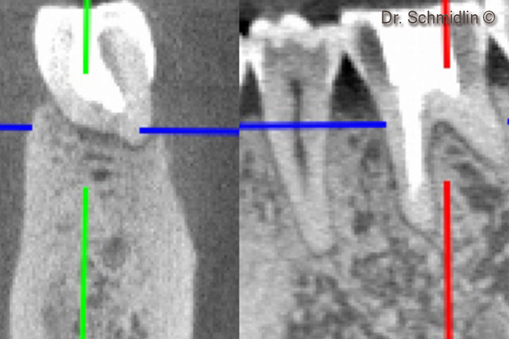 CBCT of the furcation area after 6 months