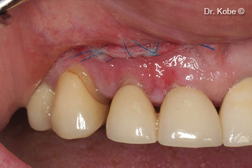 Complete wound closure after one week