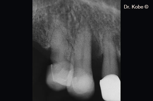 Vertical bone defect on the radiograph