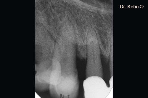 Radiograph 1 year after treatment