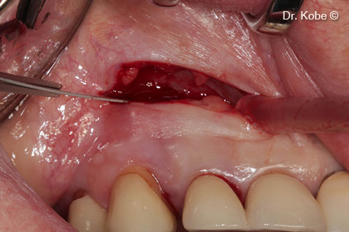 Horizontal incision (NIPSA) in the vestibule
