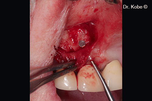 Access to the defect