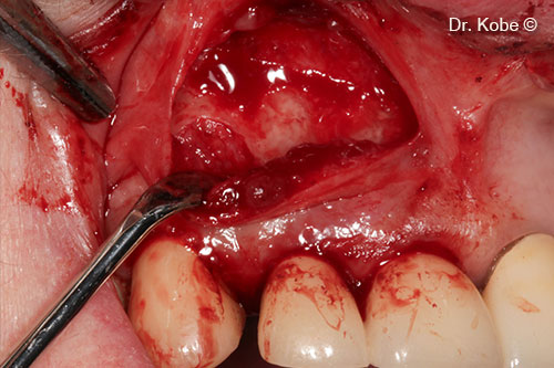Root scaling and debridement