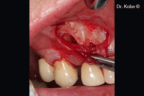 Root surface cleaned