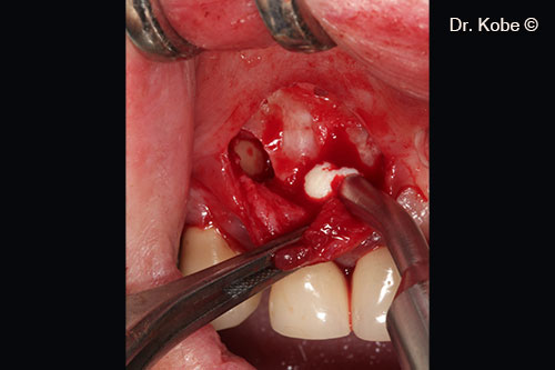 Defect filled with Gel 40