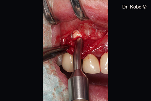 Defect filled with Gel 40