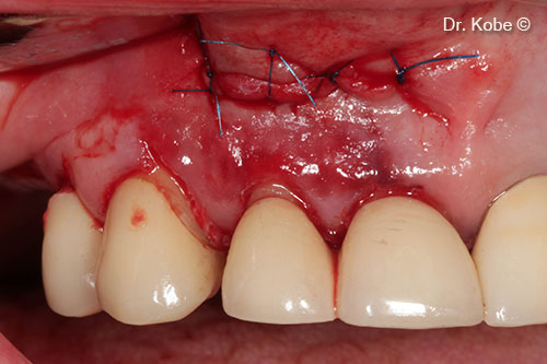 Wound sutured with interrupted sutures