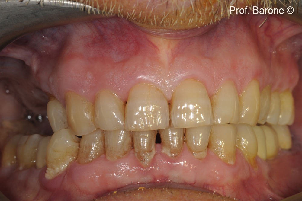 Partial edentulism first quadrant