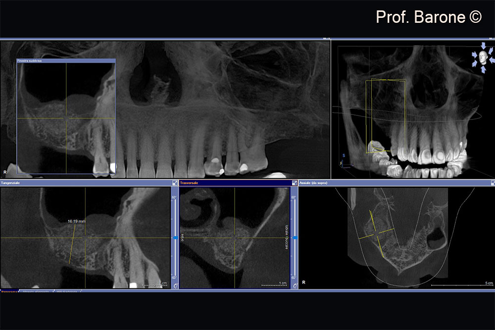 X-Ray examination 7 months after Sinus Lift