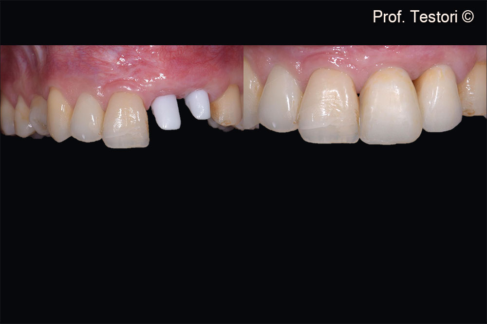 At the time of implant placement, soft tissues have healed uneventfully.