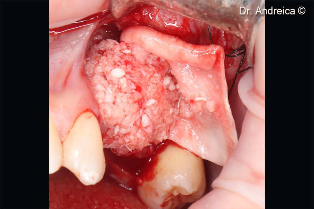 After filling the sinus and fixing the Evolution membrane we condense the bone mixture ouside the crest