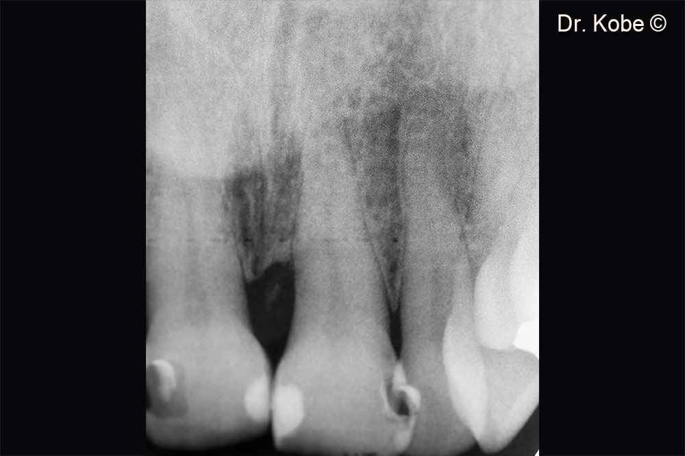 Radiograph 1 year after treatment