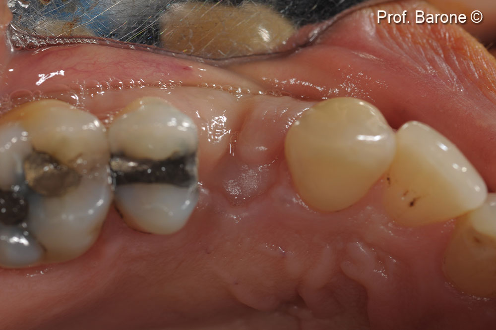 Clinical occlusal view 16 weeks after ridge preservation