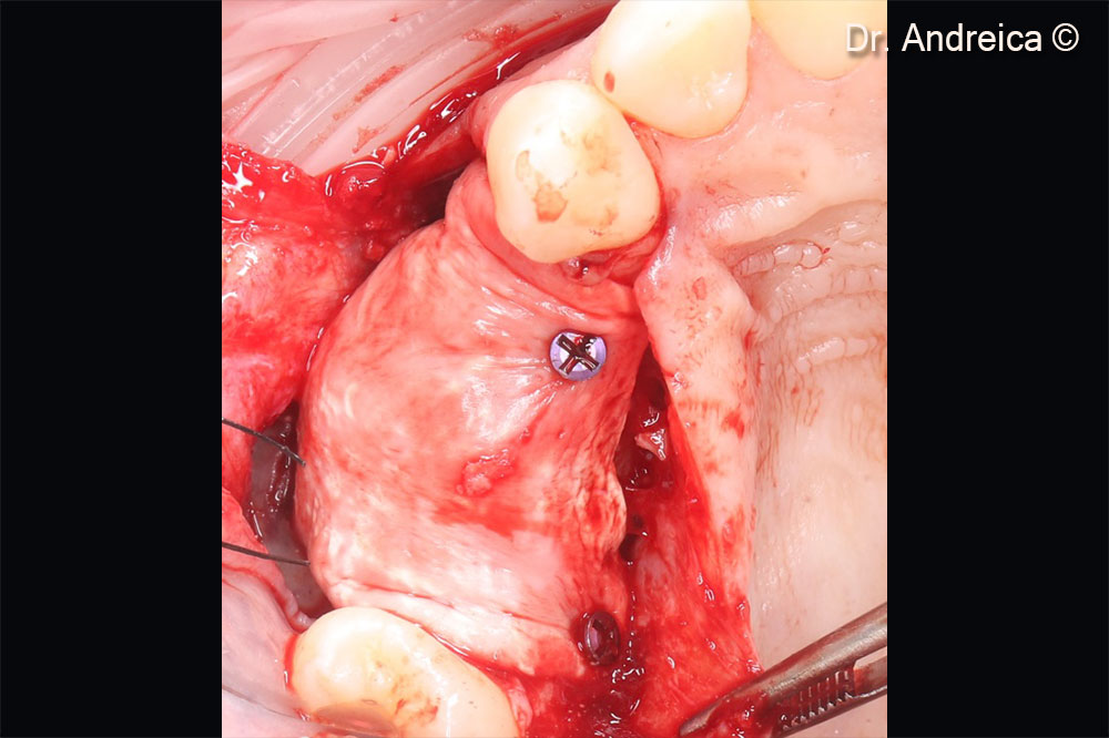 Stretching of the membrane and fixation with titanium tacks. Overgraft to compensate shrinkage
