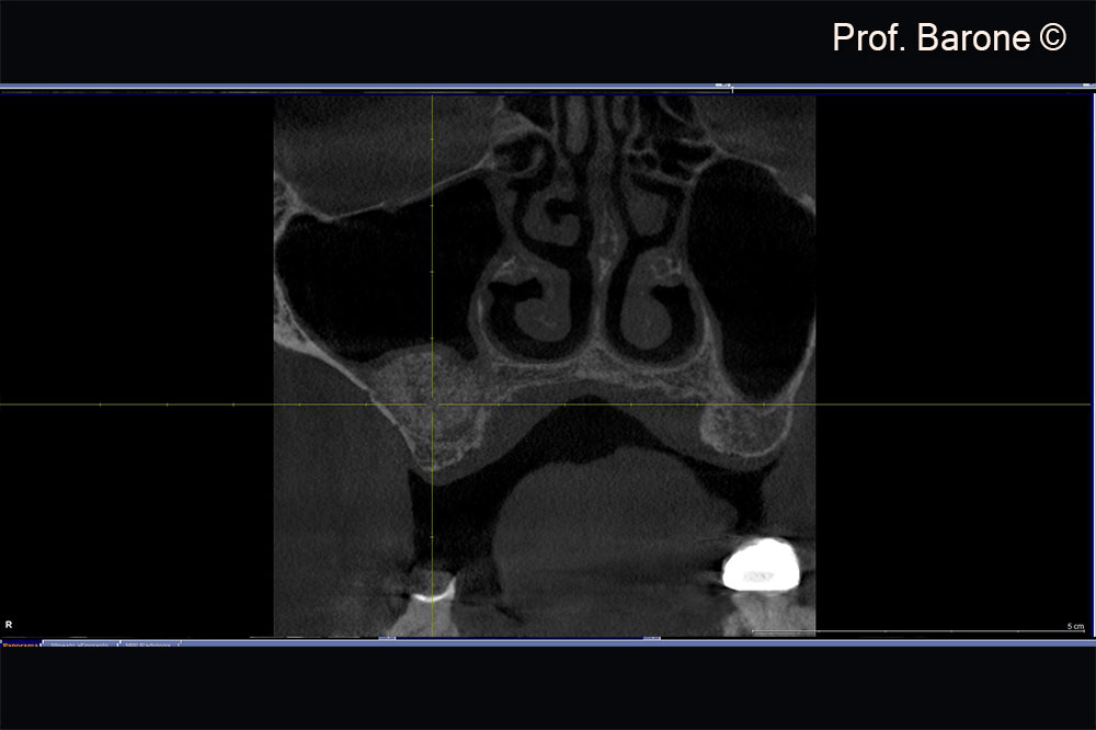 X-Ray examination 7 months after Sinus Lift