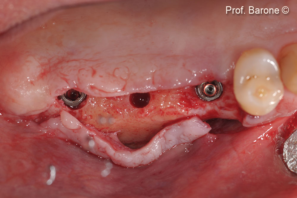 Implants placed 7 months after Sinus Lift (Biotech Implants)
