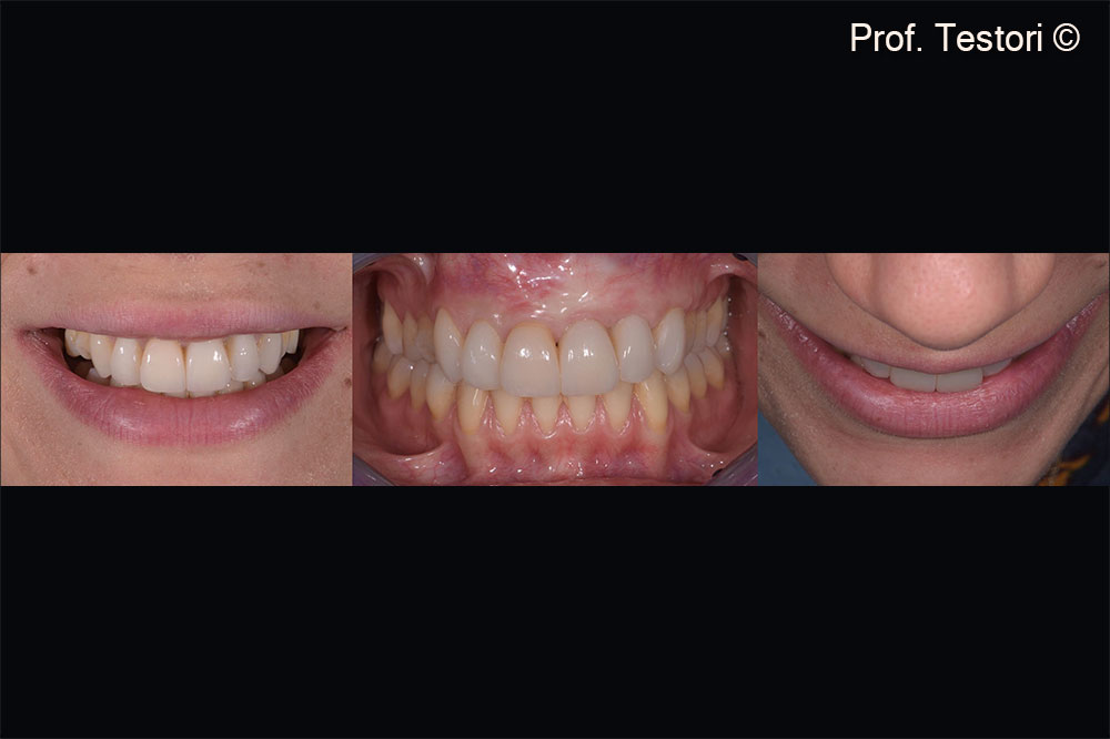 At the time of implant placement, soft tissues have healed uneventfully.