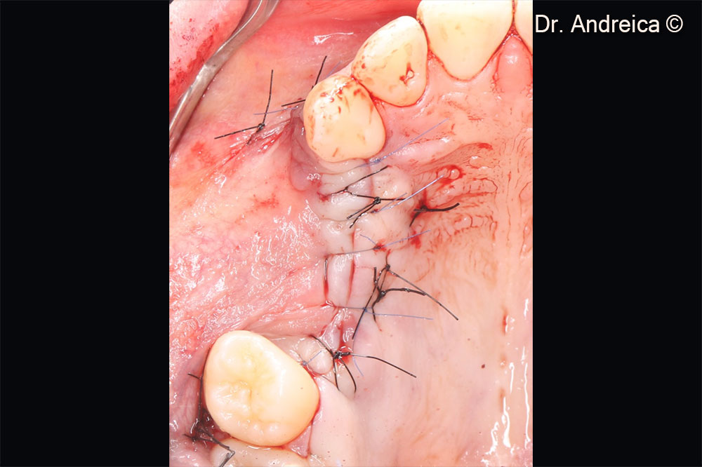 Tension free closure after periosteal releasing incisons, with Laurell-Gottlow and simple sutures