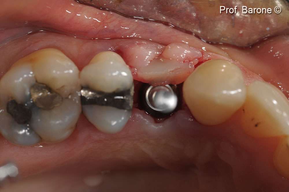 Clinical occlusal view during implant site preparation