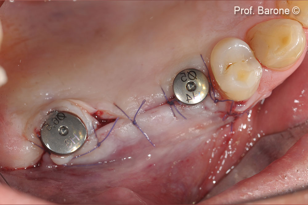 Healing abutments were stabilized over implants