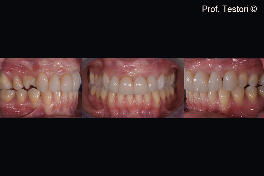 At the time of implant placement, soft tissues have healed uneventfully.