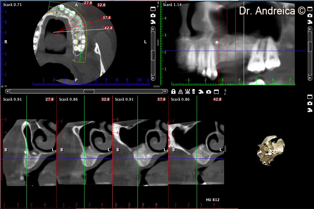CBCT scan 5 months after surgery revealing the amount of bone that was augmented