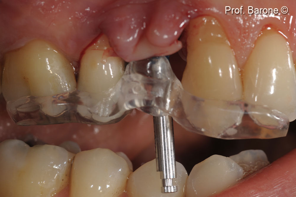 Clinical lateral view during implant site preparation